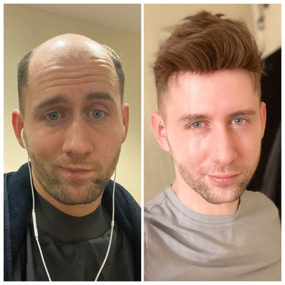 What You Should Pay Attention to when You Choose Men's Hair System Tape? What You Should Pay Attention to when You Choose Men's Hair System Tape?