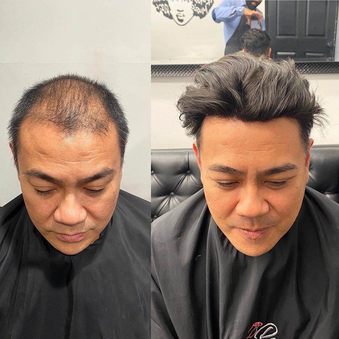 I'm Facing A Thinning Hair Issue! What Are the Reasons And What Can I Do? I'm Facing A Thinning Hair Issue! What Are the Reasons And What Can I Do?