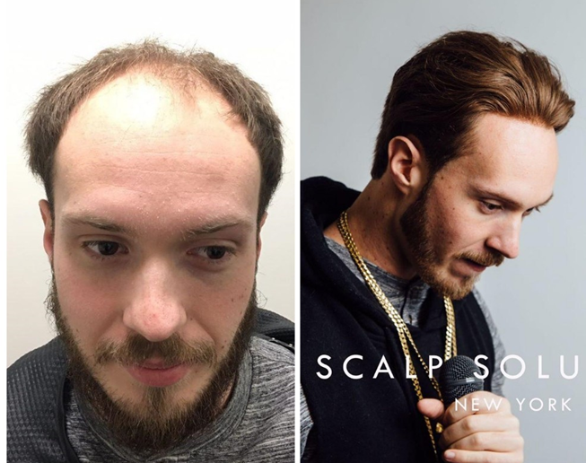 lavivid hair thinning solution