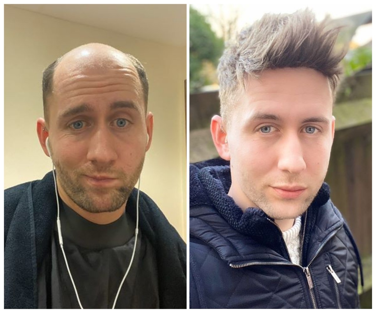 lavivid hair system before and after