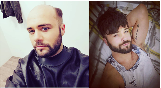 Lavivid before and after