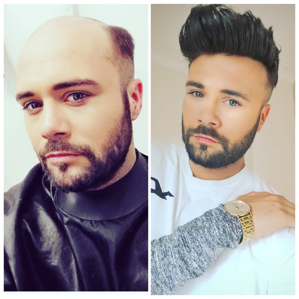 hair system before and after