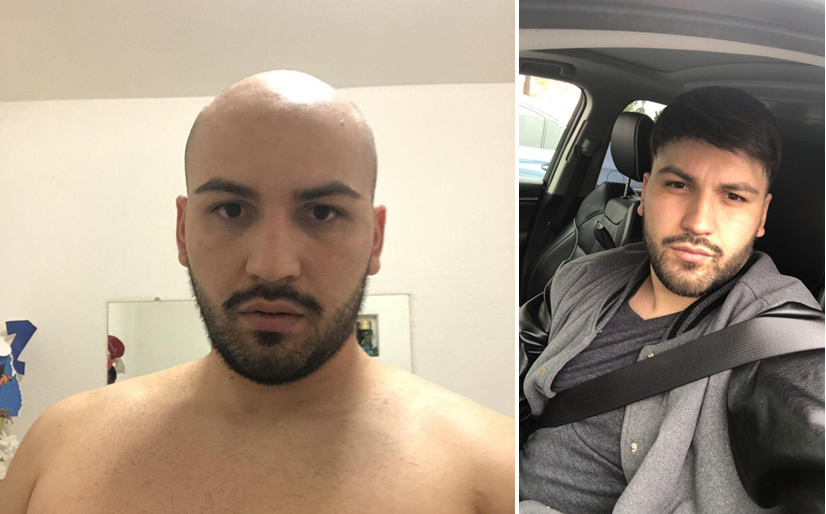 hair system before and after