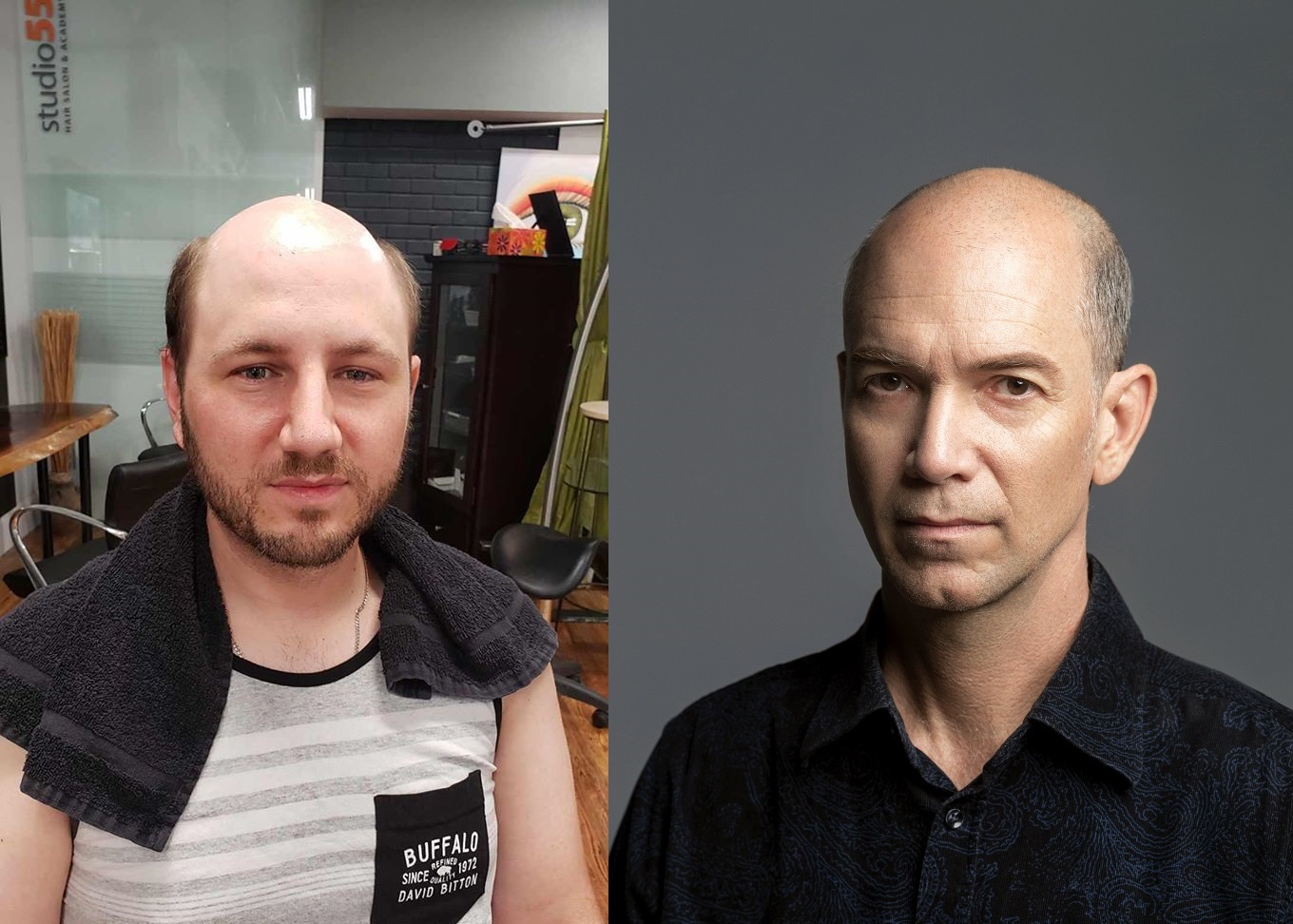 men's hair loss