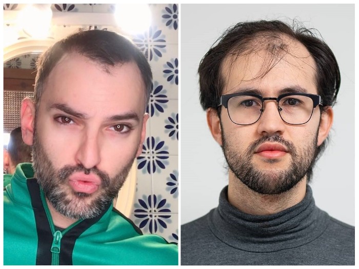 receding hairline
