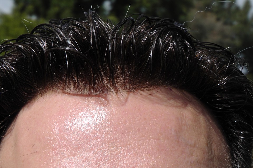 shine hairline