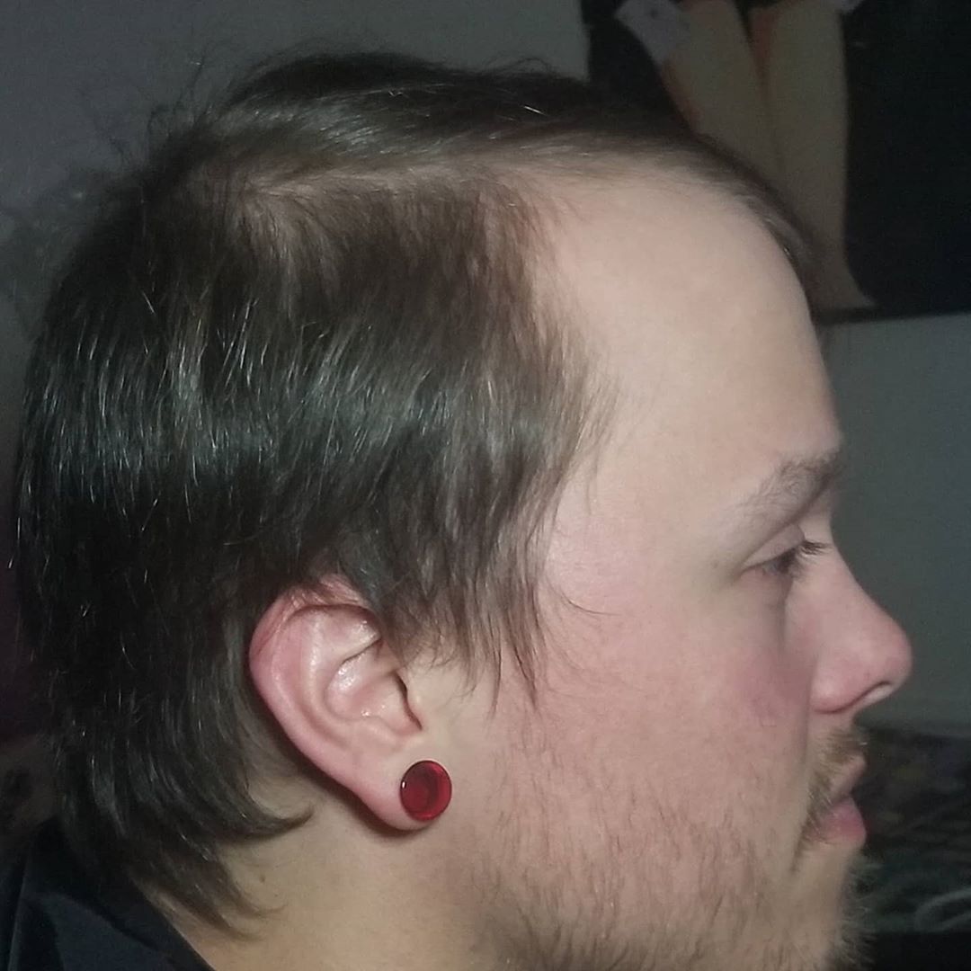Why You Should Try Hair Loss Treatment Dubai? Why You Should Try Hair Loss Treatment Dubai?