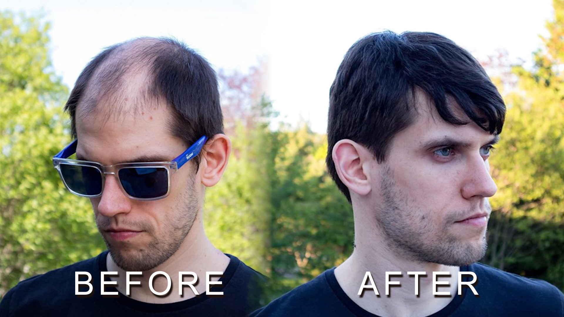 How to Maintain the Hair Loss Treatment Glasgow? How to Maintain the Hair Loss Treatment Glasgow?