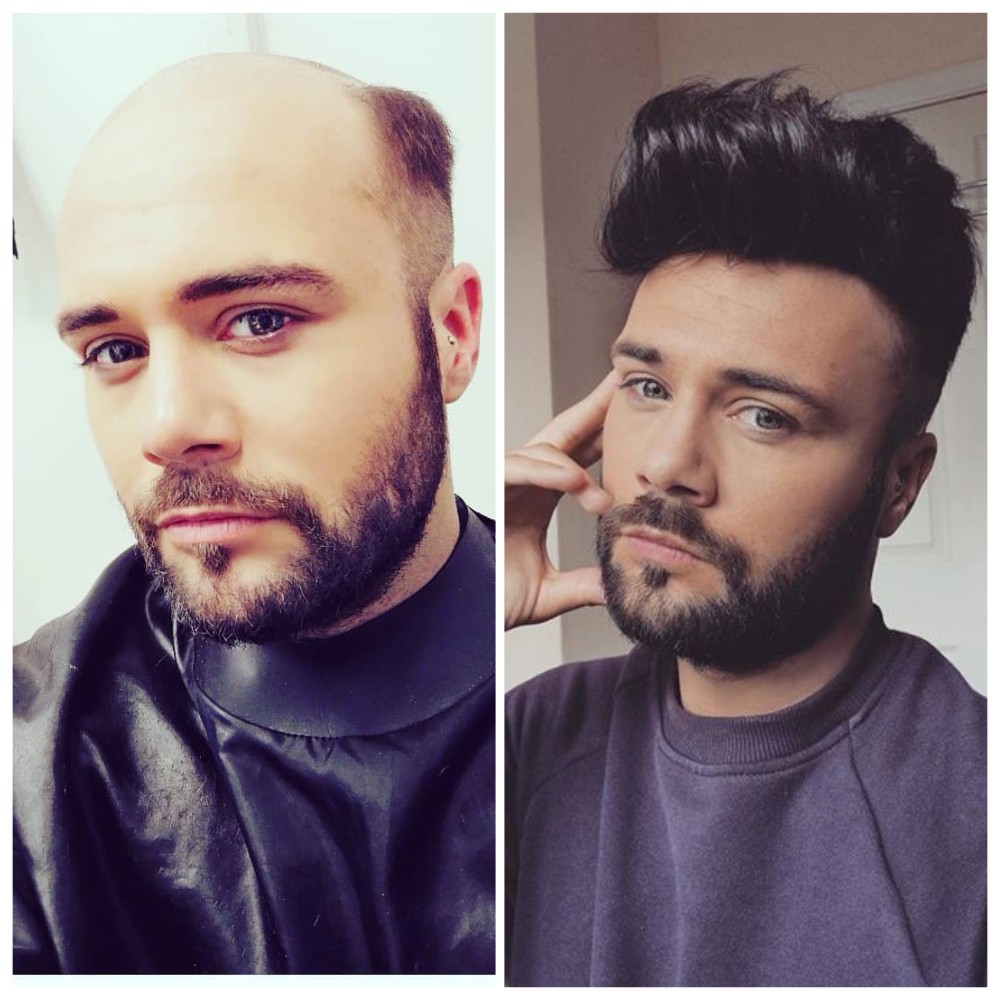 How Do Teenage Boys Dea with Hair Loss? How Do Teenage Boys Dea with Hair Loss?