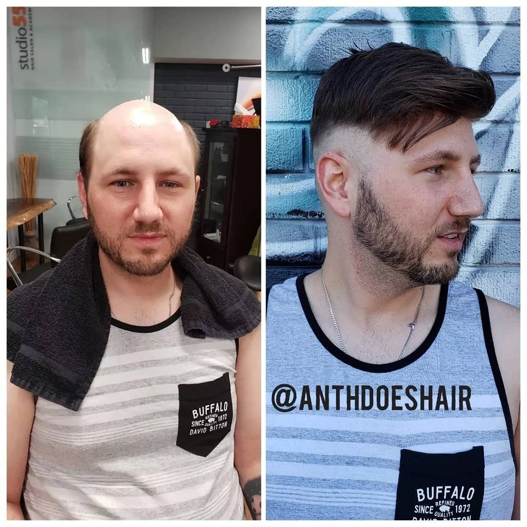 What's the Changes Appear When Wearing Men's Hair System Before and After