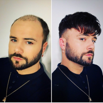 Will Vitamin B Have An Effect on Hair Loss?