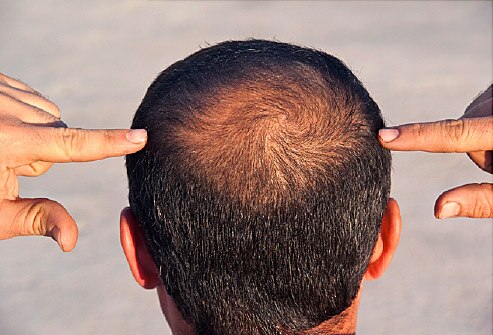 Vertex Baldness