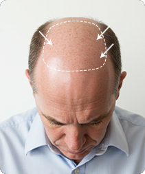 Toupee