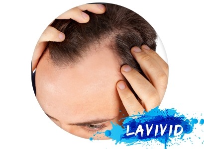 My Hair Loss Story and the Best Hair Solution I've Taken
