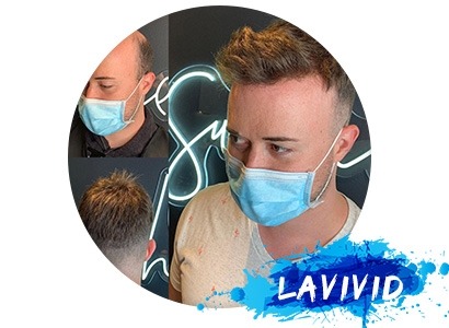 Which One Should I Choose? Full Cap Wigs or Hair Systems?