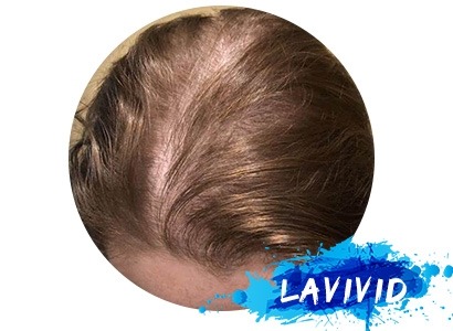 What Causes Women’s Thinning Hair?