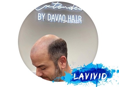 Does Christian Siriano Wear a Hairpiece?