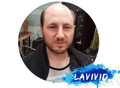 The Most Complete and Detailed Guide for Male Hair Loss Treatment