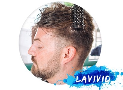 Is the Hair Replacement System Worth It?