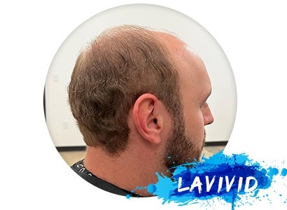 Hair System 101 - How to Take the Weekly Maintenance of Your Hair Replacement System