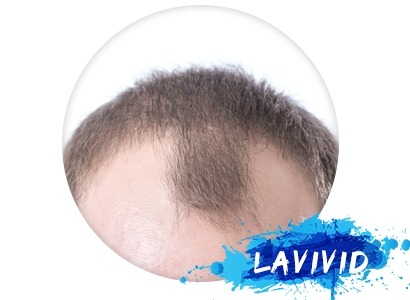 Tutorials about Choosing the Best Fit Male Hair Piece?