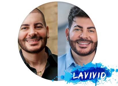 How Common Is Male Hair Loss? When to Consider a Hair System
