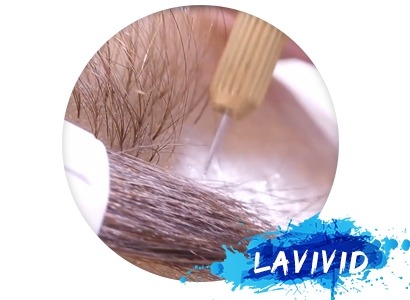 How to Treat with the Hair Loss Problems?