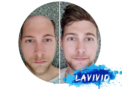 How to Solve the Losing Hair Crown Male?