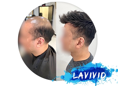 How To Deal with Thinning Hair from Crown?