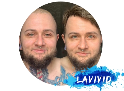 What Need to Know about the Hair System for Bald Men?