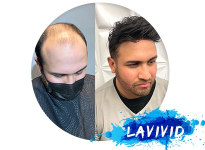 3 Alternatives for You to Choose Hair Replacement Systems