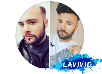 All You Need to Know About Male Pattern Hair Loss