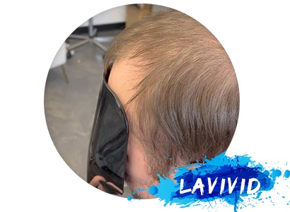 The Luxury of European Hair: Lavivid's Exclusive 15% Off Offer on Hair Systems