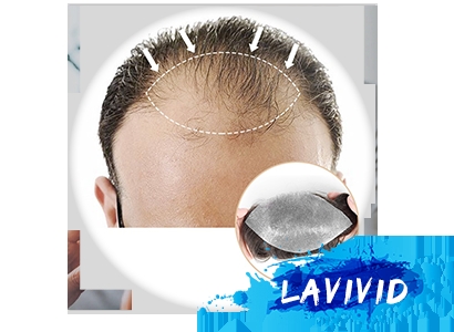 Hair Loss Dilemma: Decoding Transplants vs. Systems