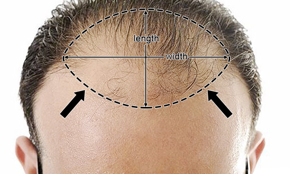 Hair Patches for Heavy Receding