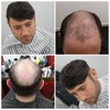 Achilles Men's Hair Unit | 0.10-0.12mm Full Skin Base | Men's Hairstyle for Thin Hair review