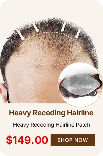 HEAVY RECEDING HAIRLINE PATCH